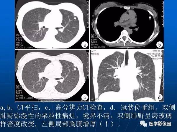 【PPT】各型肺结核的典型影像表现