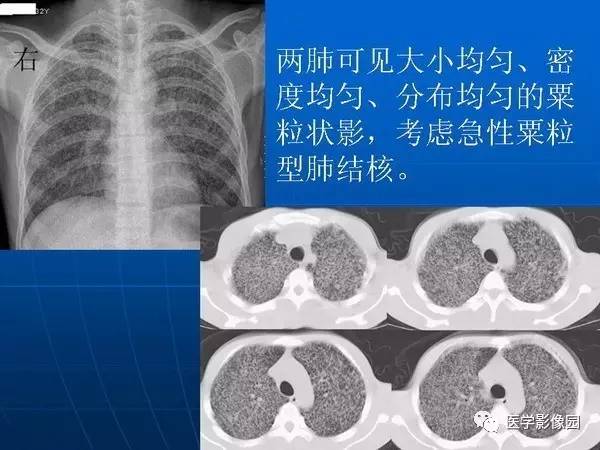 【PPT】各型肺结核的典型影像表现
