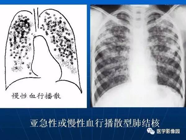 【PPT】各型肺结核的典型影像表现