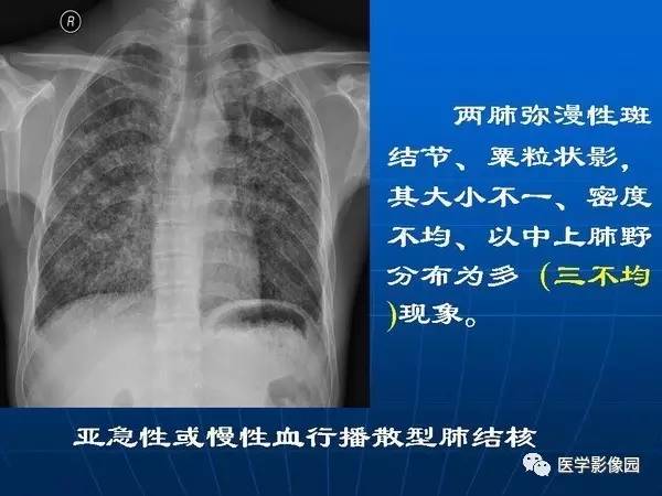 【PPT】各型肺结核的典型影像表现