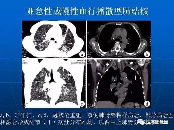 【PPT】各型肺结核的典型影像表现