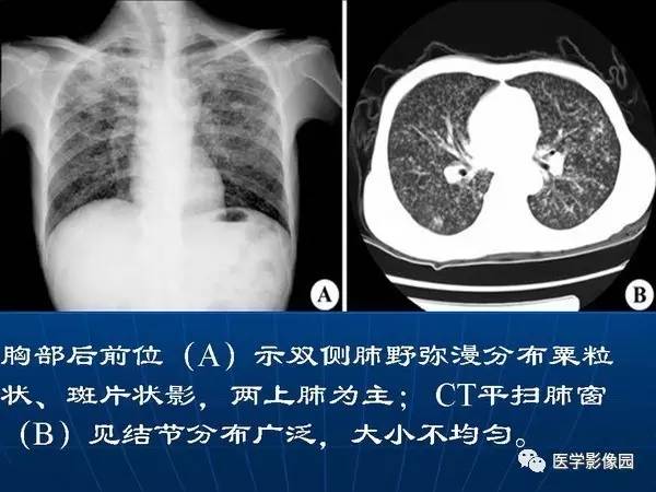 【PPT】各型肺结核的典型影像表现