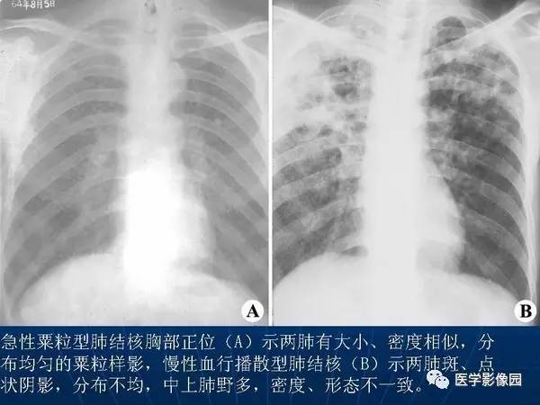【PPT】各型肺结核的典型影像表现