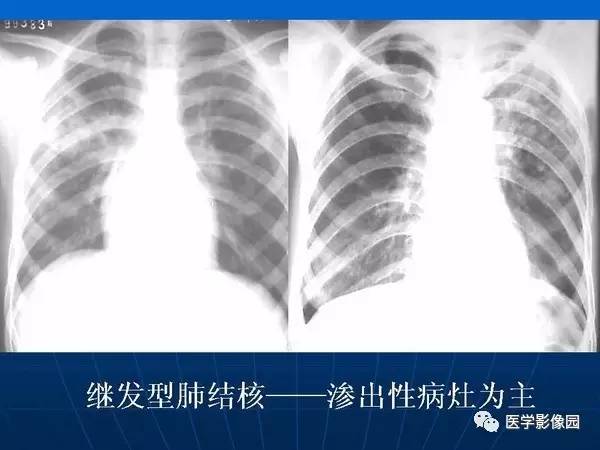 【PPT】各型肺结核的典型影像表现