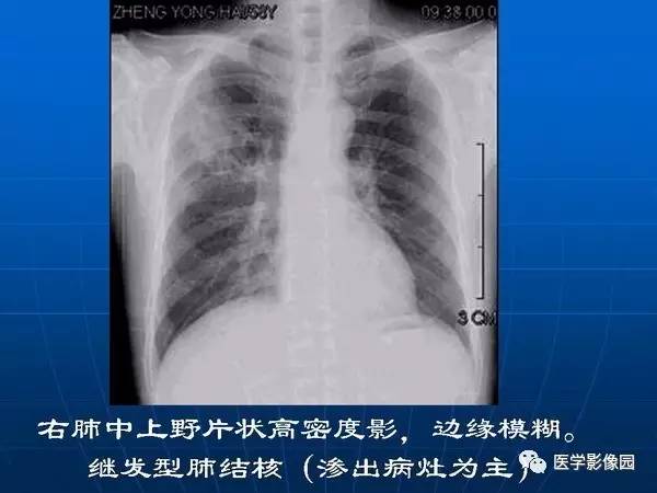 【PPT】各型肺结核的典型影像表现