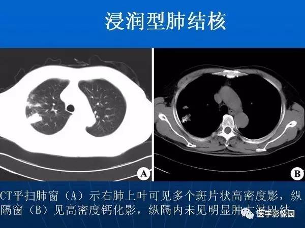 【PPT】各型肺结核的典型影像表现