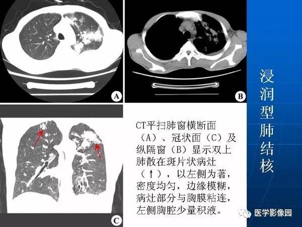 【PPT】各型肺结核的典型影像表现