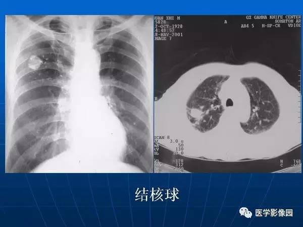 【PPT】各型肺结核的典型影像表现