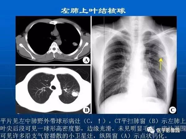 【PPT】各型肺结核的典型影像表现