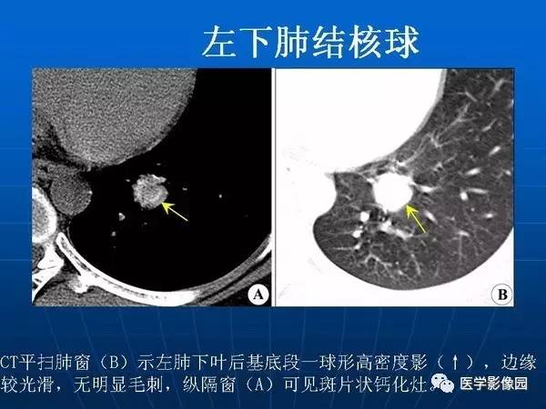 【PPT】各型肺结核的典型影像表现