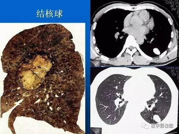 【PPT】各型肺结核的典型影像表现