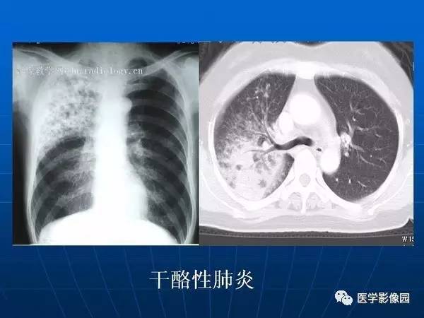 【PPT】各型肺结核的典型影像表现