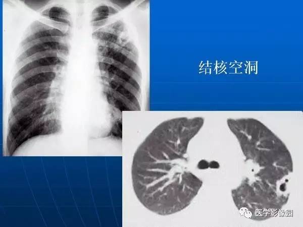 【PPT】各型肺结核的典型影像表现
