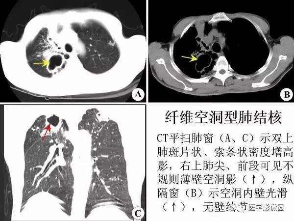 【PPT】各型肺结核的典型影像表现