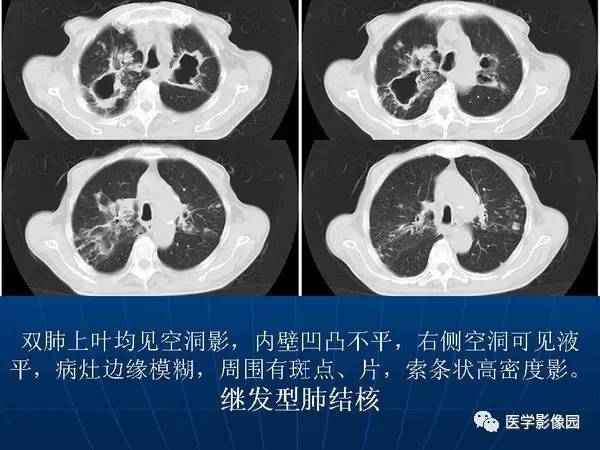 【PPT】各型肺结核的典型影像表现