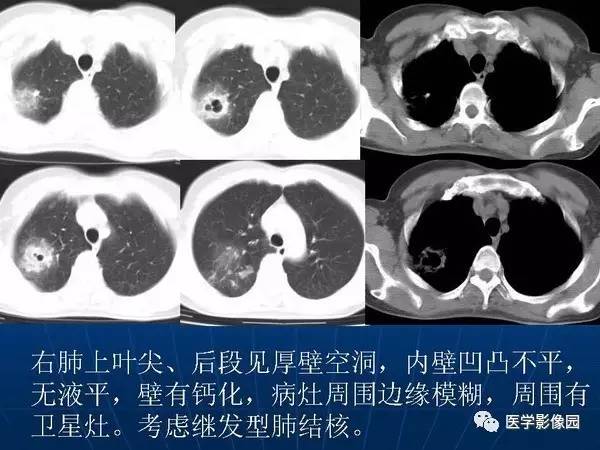 【PPT】各型肺结核的典型影像表现