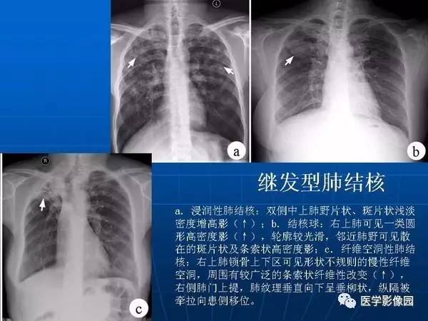 【PPT】各型肺结核的典型影像表现