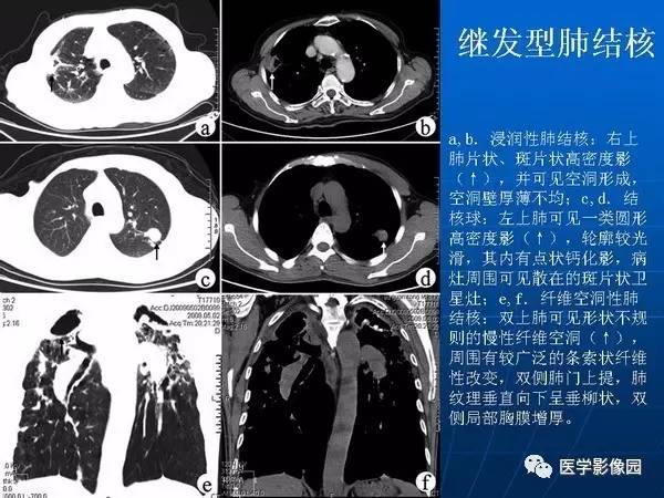 【PPT】各型肺结核的典型影像表现