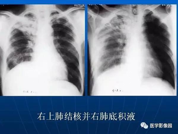 【PPT】各型肺结核的典型影像表现