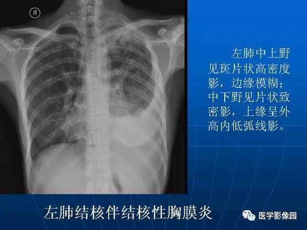 【PPT】各型肺结核的典型影像表现