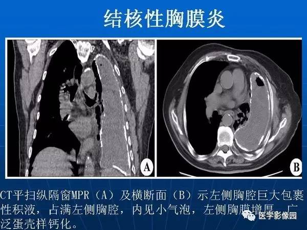 【PPT】各型肺结核的典型影像表现