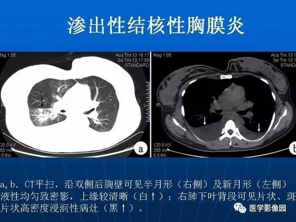 【PPT】各型肺结核的典型影像表现