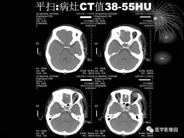 【病例】原发眼眶淋巴瘤1例CT影像表现 【病例】原发眼眶淋巴瘤1例CT影像表现