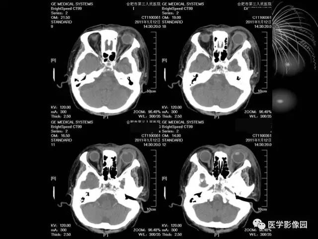 【病例】原发眼眶淋巴瘤1例CT影像表现 【病例】原发眼眶淋巴瘤1例CT影像表现