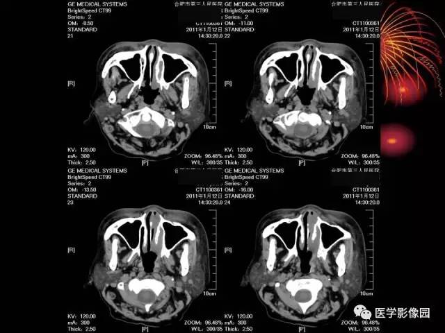 【病例】原发眼眶淋巴瘤1例CT影像表现 【病例】原发眼眶淋巴瘤1例CT影像表现