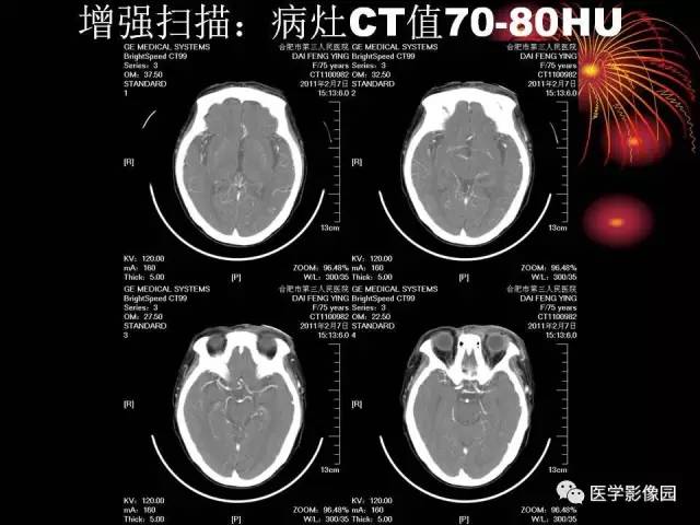 【病例】原发眼眶淋巴瘤1例CT影像表现 【病例】原发眼眶淋巴瘤1例CT影像表现