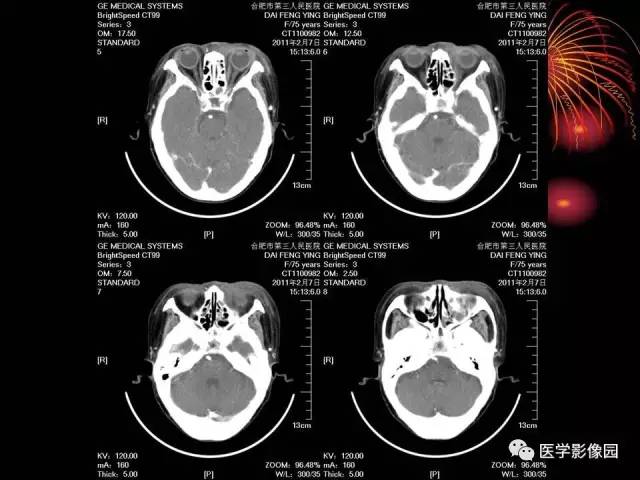 【病例】原发眼眶淋巴瘤1例CT影像表现 【病例】原发眼眶淋巴瘤1例CT影像表现