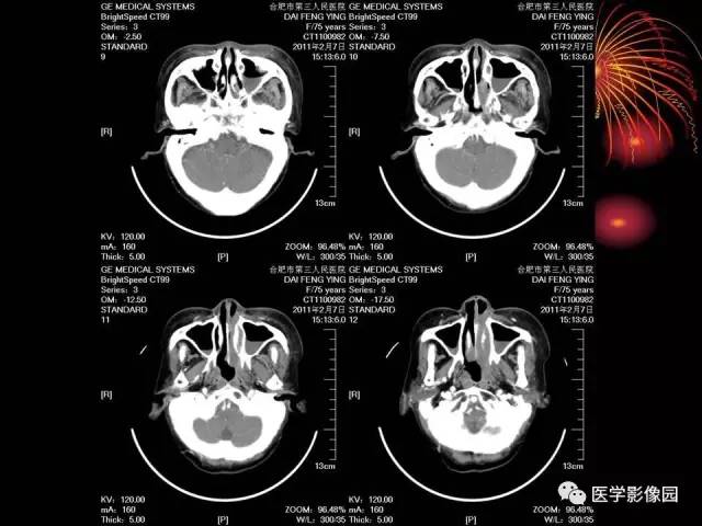 【病例】原发眼眶淋巴瘤1例CT影像表现 【病例】原发眼眶淋巴瘤1例CT影像表现
