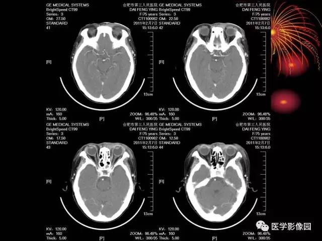 【病例】原发眼眶淋巴瘤1例CT影像表现 【病例】原发眼眶淋巴瘤1例CT影像表现