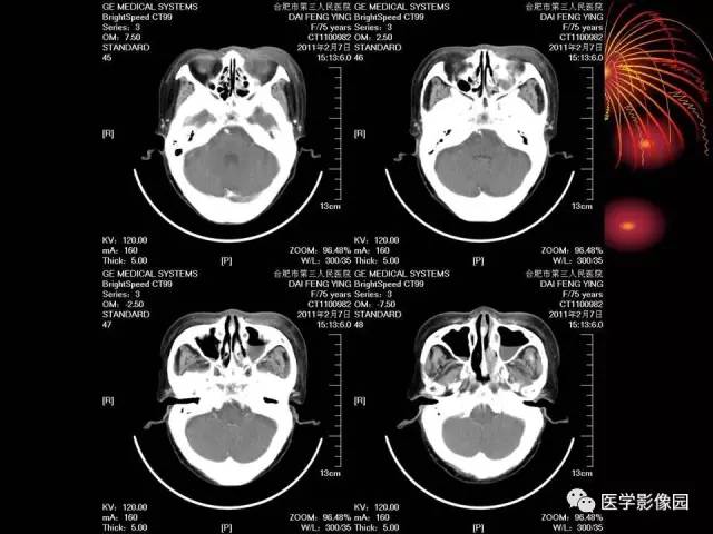 【病例】原发眼眶淋巴瘤1例CT影像表现 【病例】原发眼眶淋巴瘤1例CT影像表现