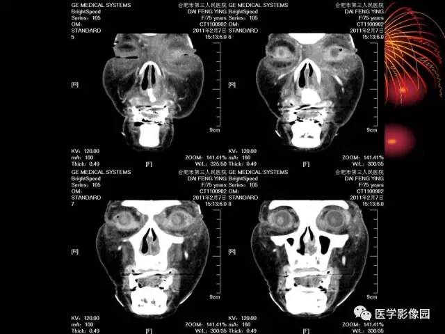 【病例】原发眼眶淋巴瘤1例CT影像表现 【病例】原发眼眶淋巴瘤1例CT影像表现