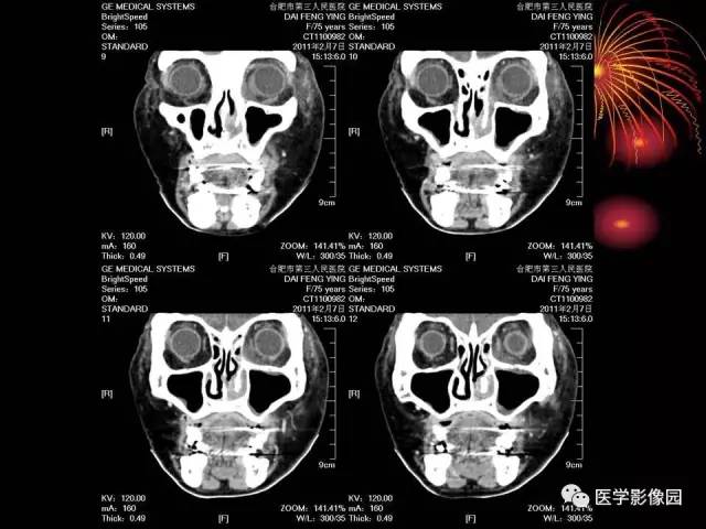 【病例】原发眼眶淋巴瘤1例CT影像表现 【病例】原发眼眶淋巴瘤1例CT影像表现