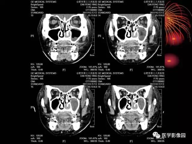 【病例】原发眼眶淋巴瘤1例CT影像表现 【病例】原发眼眶淋巴瘤1例CT影像表现