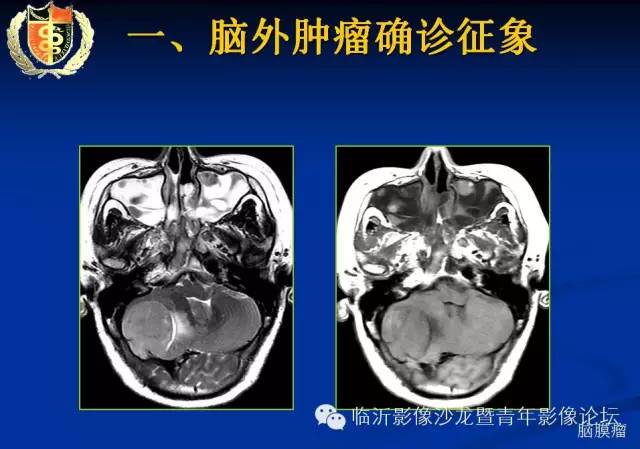 【PPT】颅内肿瘤的影像学定位诊断