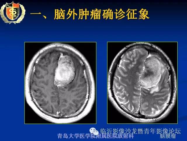 【PPT】颅内肿瘤的影像学定位诊断