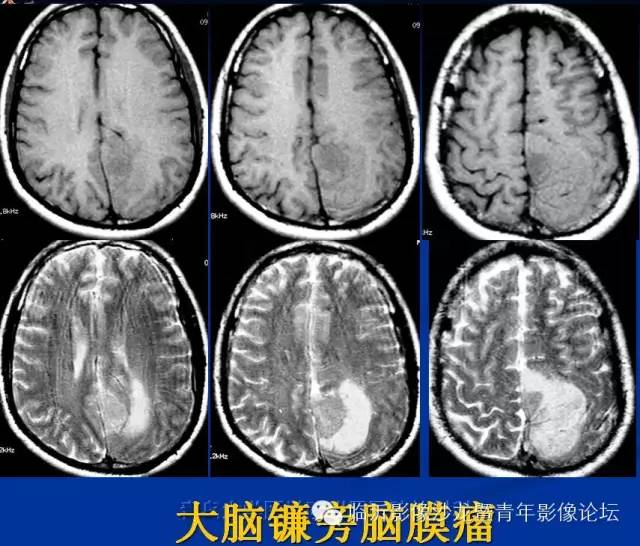 【PPT】颅内肿瘤的影像学定位诊断