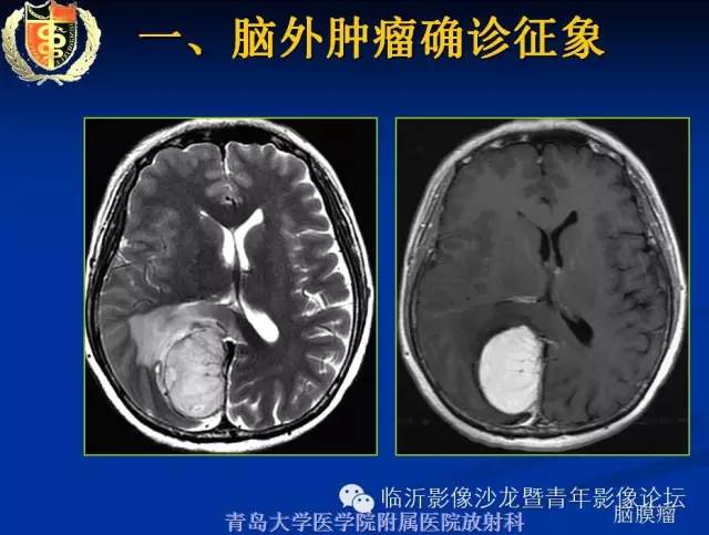 【PPT】颅内肿瘤的影像学定位诊断
