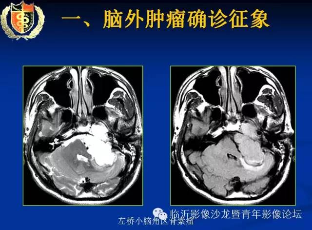 【PPT】颅内肿瘤的影像学定位诊断