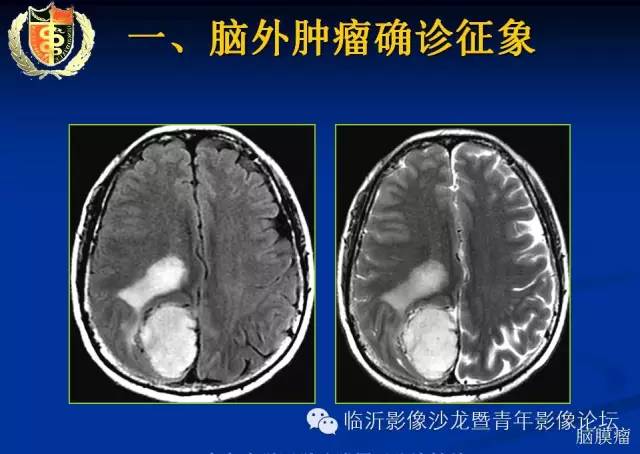 【PPT】颅内肿瘤的影像学定位诊断
