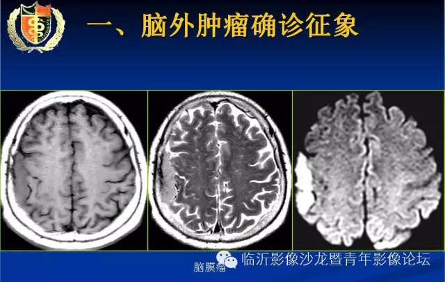 【PPT】颅内肿瘤的影像学定位诊断