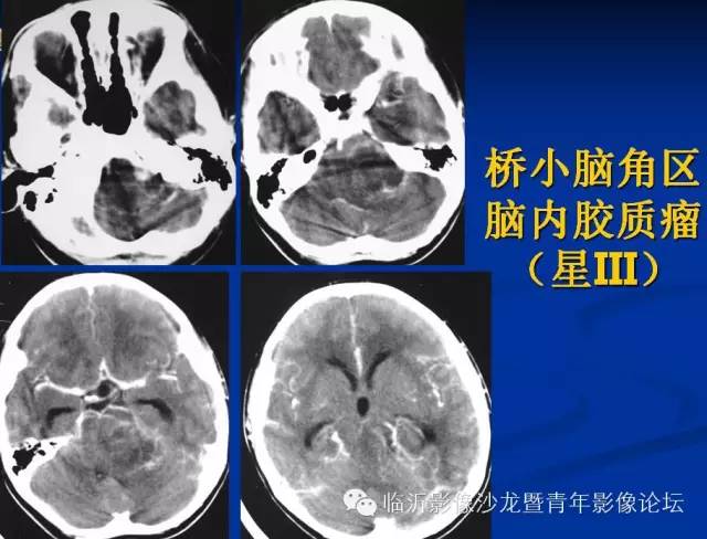 【PPT】颅内肿瘤的影像学定位诊断