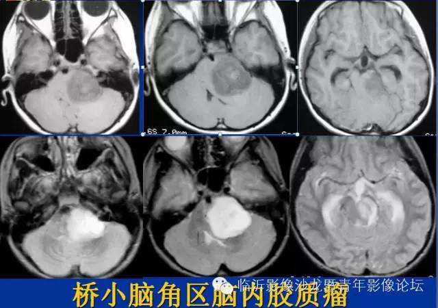 【PPT】颅内肿瘤的影像学定位诊断