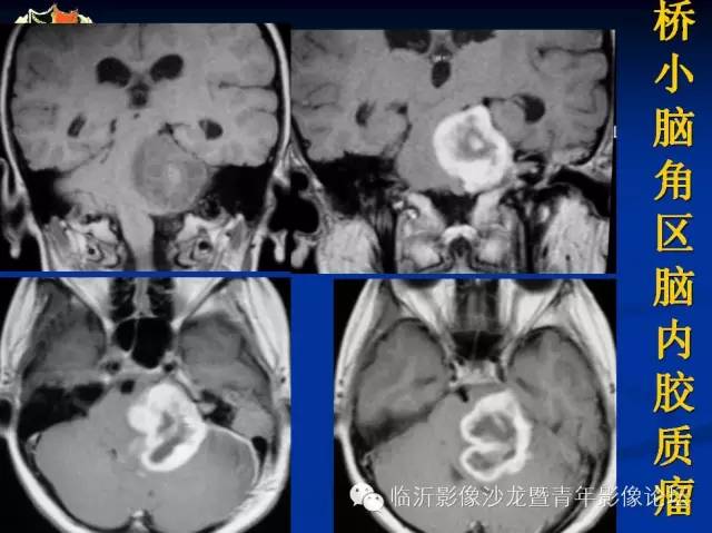 【PPT】颅内肿瘤的影像学定位诊断