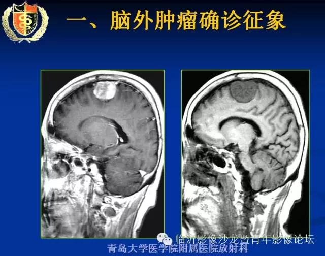 【PPT】颅内肿瘤的影像学定位诊断