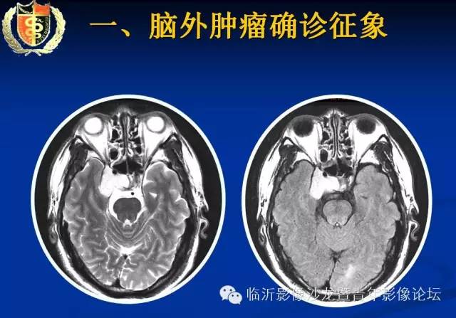 【PPT】颅内肿瘤的影像学定位诊断