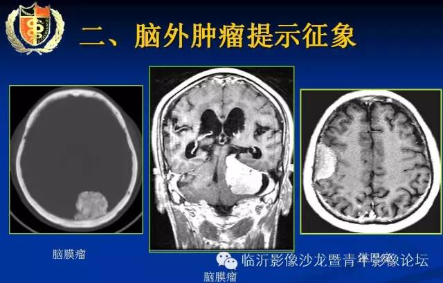 【PPT】颅内肿瘤的影像学定位诊断